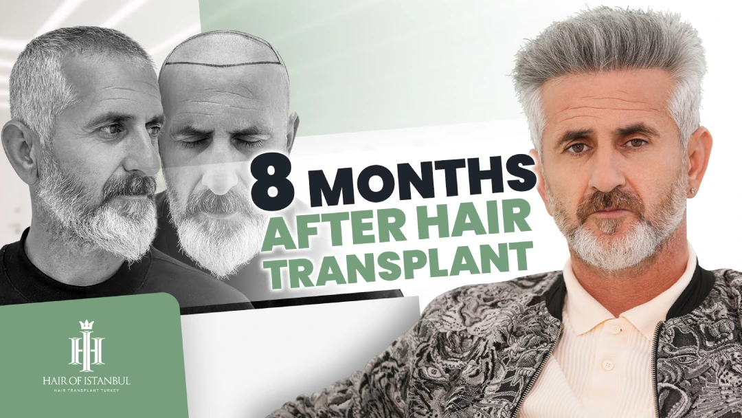 8 AYDA DEĞİŞİM: HAIR OF ISTANBUL’DA FUE SAÇ EKİMİ SONUÇLARI 