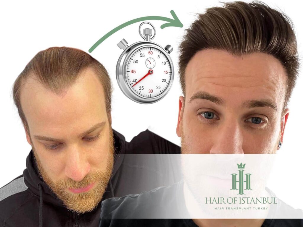 Hair transplant recovery time in turkey key stages