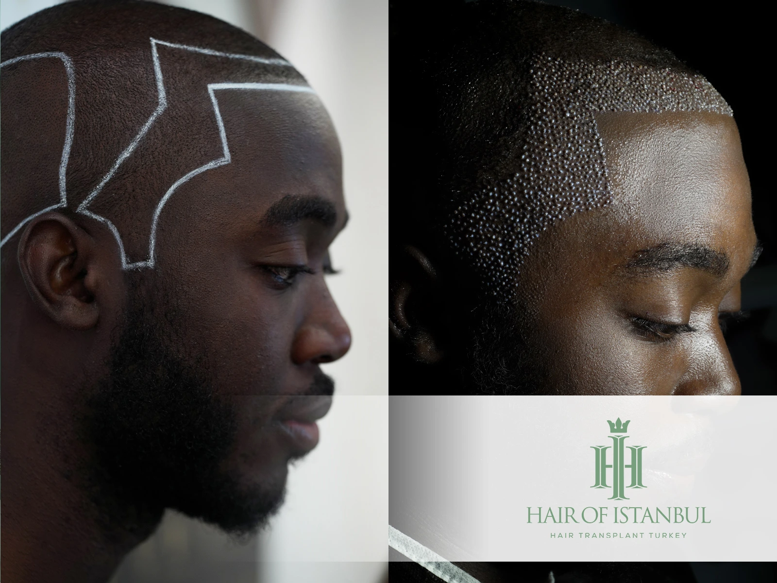 Afro Hair Transplant at Hair of Istanbul: Challenges, Solutions & Results