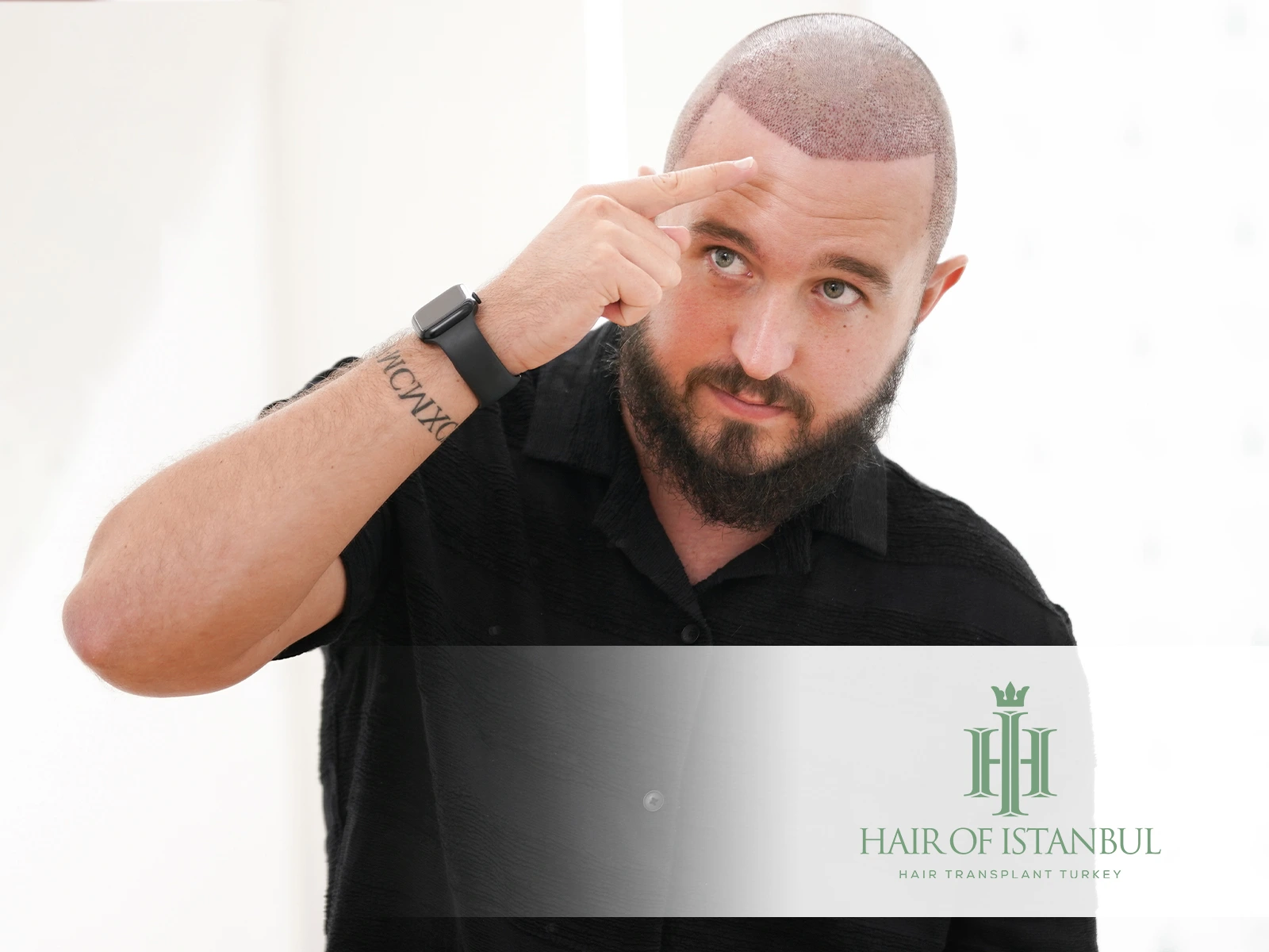 Are Hair Transplants Permanent? What You Need to Know in 2025