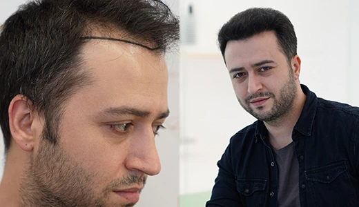Before and After Hair Transplant More Than Just Hair