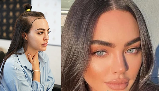 Before and After Hair Transplant Results for Women