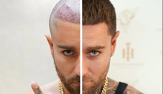 Before and After Hair Transplant The Transformation
