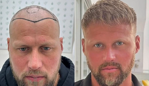 Before and After Hair Transplant What Results Can You Expect
