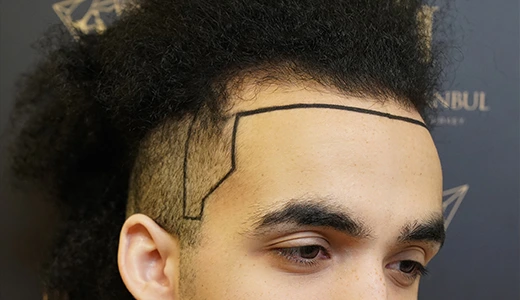 Before and After Hair Transplant What to Expect