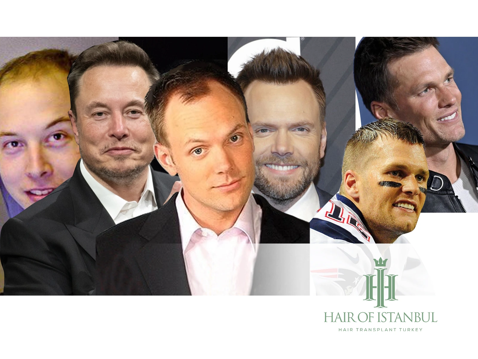 Celebrity Hair Transplant: Hair of Istanbul’s 2025 Transformations with FUE & DHI