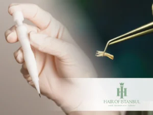 DHI and FUE Method: The Science Behind Extraction and Implantation 4 DHI Hair Transplant Explained Benefits Process and Results