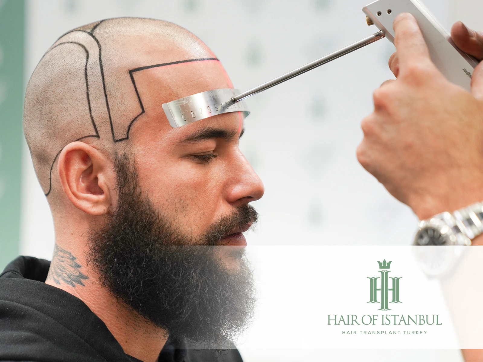Designing the Perfect Hairline: The Artistic Approach of Hair of Istanbul
