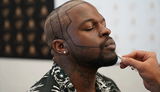 Do Afro Hair Transplant Results Last Forever