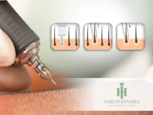 Hair Transplant Scar: Complete 2025 Guide to Scarring, Healing, and Minimizing Visibility 2 FUE Hair Transplant