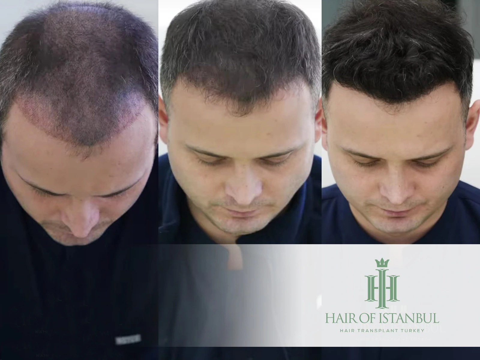 Hair Transplant Before and After: 198-Day Transformation Explained