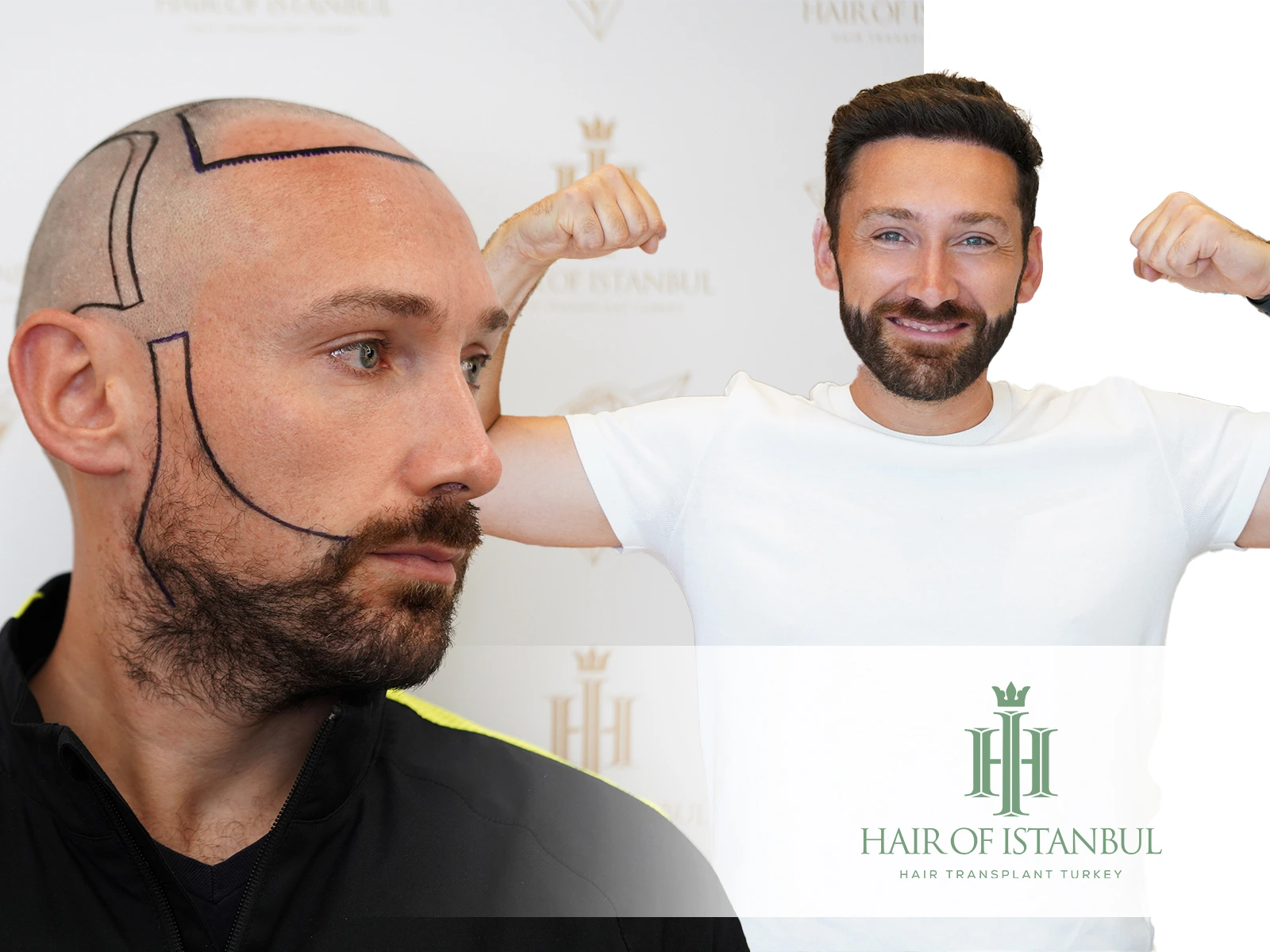 Hair Transplant Images: Real Before and After Results That Inspire