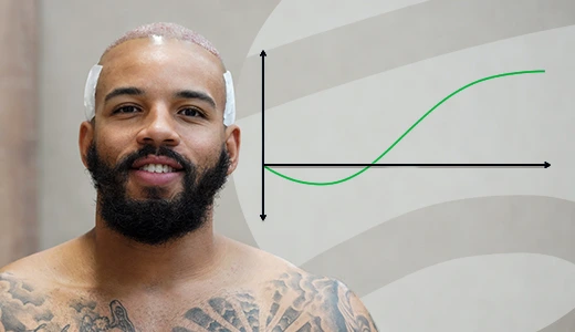 Hair Transplant Recovery Timeline Key Milestones