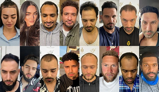 Hair Transplant Results Hair Transplant Images Before and After