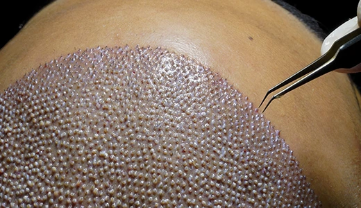 Hair Transplant Success Rate and Regrowth Time