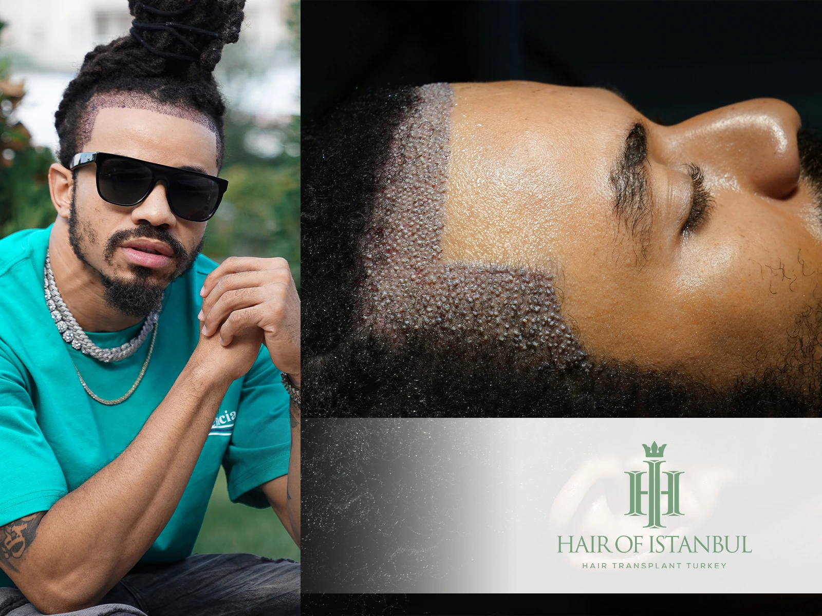 Hair Transplant Without Shaving: Why Hair Transplant Turkey Is the Best Option