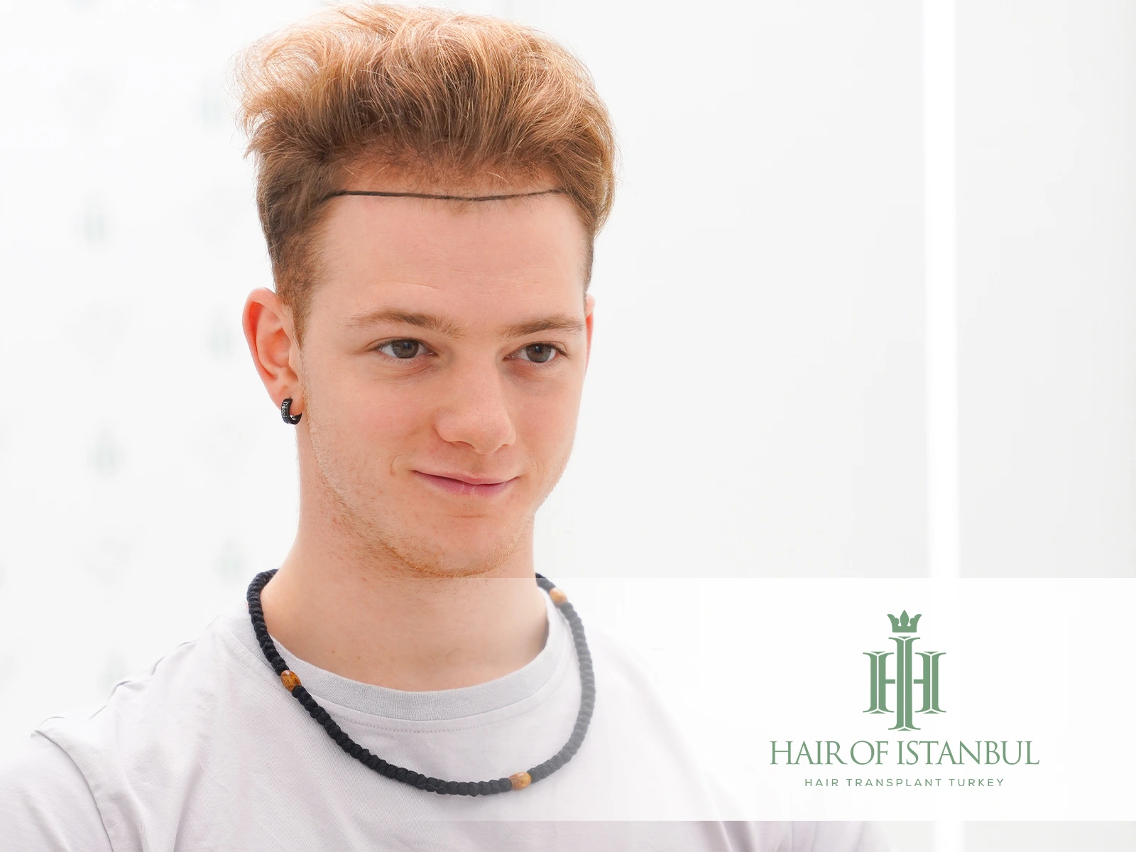 Hair Transplant for Receding Hairline: Natural Results That Last