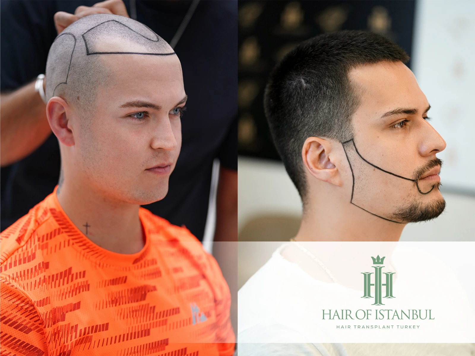 Hair and Beard Transplant Aesthetics: Hair Transplant Turkey in 2025
