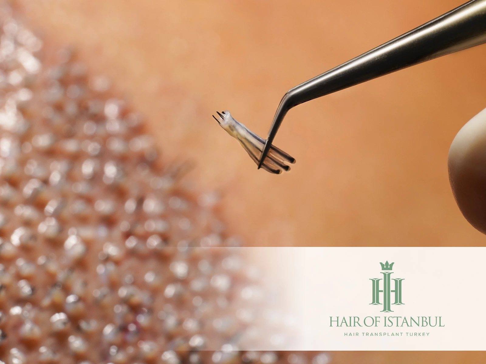 Post Hair Transplant: Recovery Timeline, Aftercare & Day-by-Day Healing