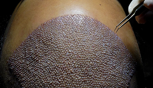 What Is DHI Hair Transplant