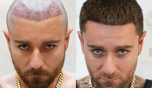 Why Hair Transplant Images Matter