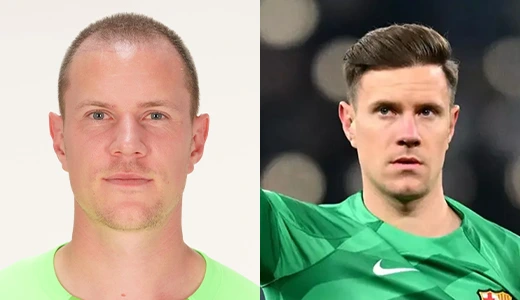 ter stegen hair transplant