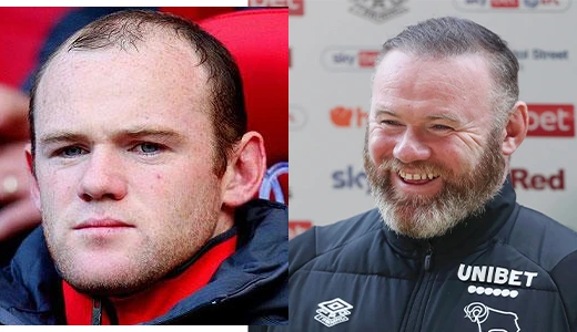 wayne rooney hair transplant