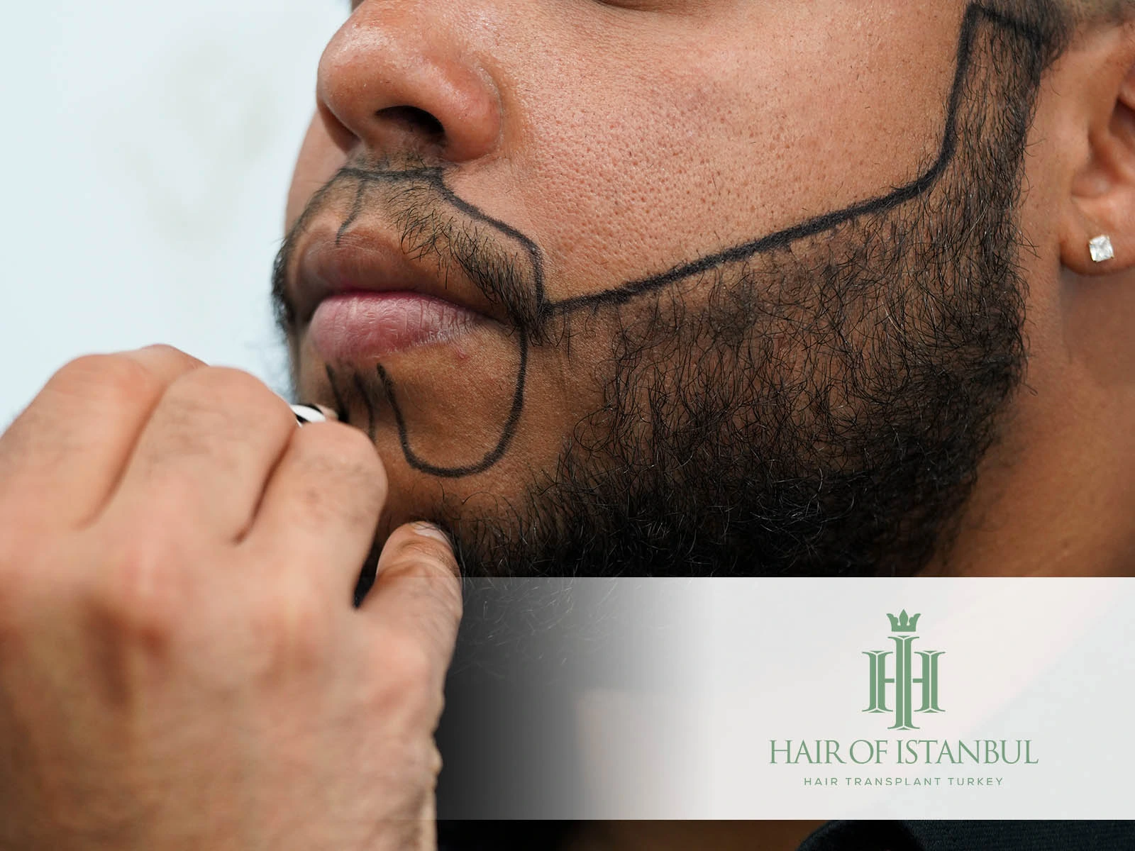 Beard Hair Transplant Results: What to Expect and How to Maximize Them