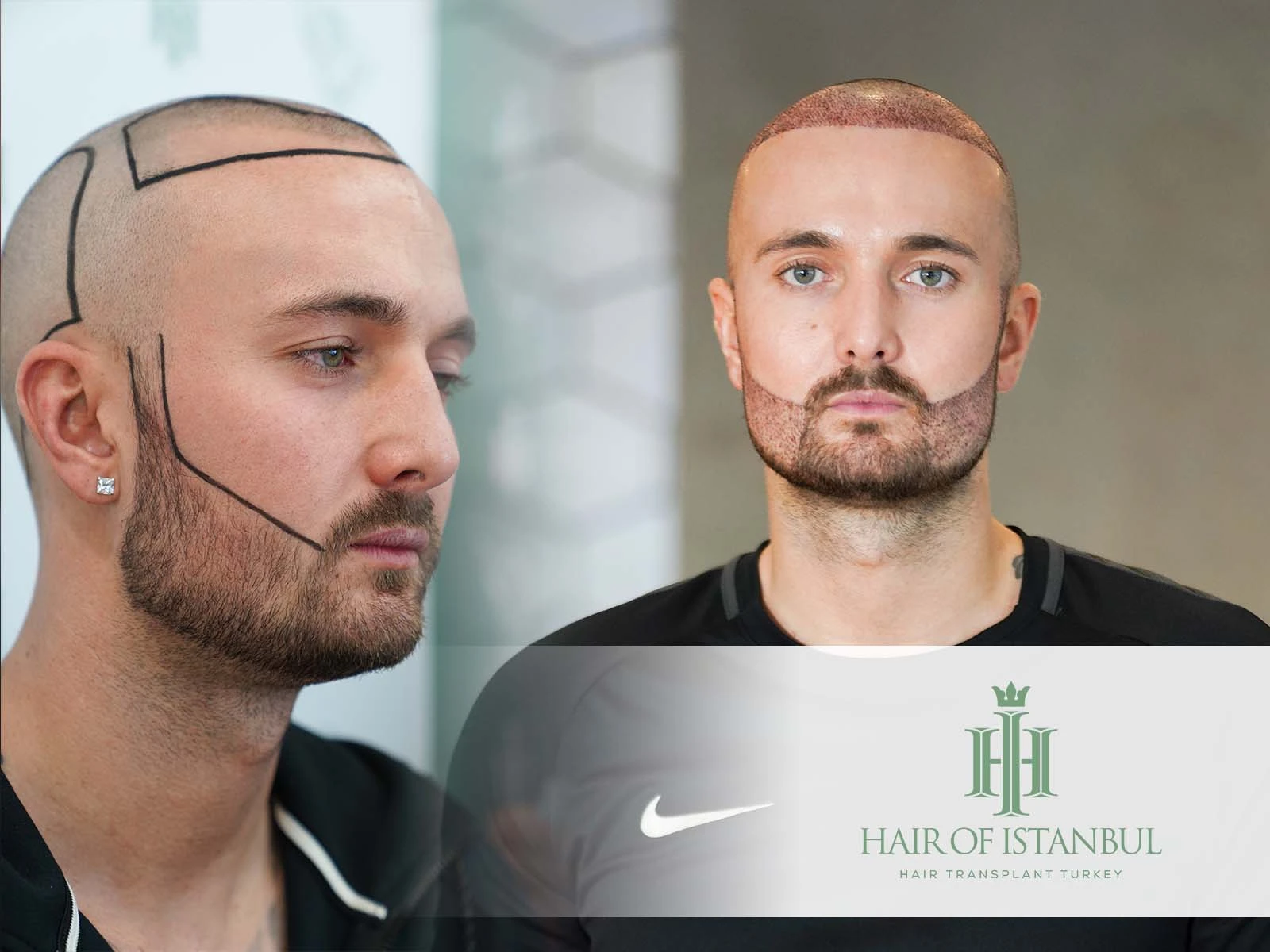 Beard Transplant: The Rising Trend for a Defined Look in 2025