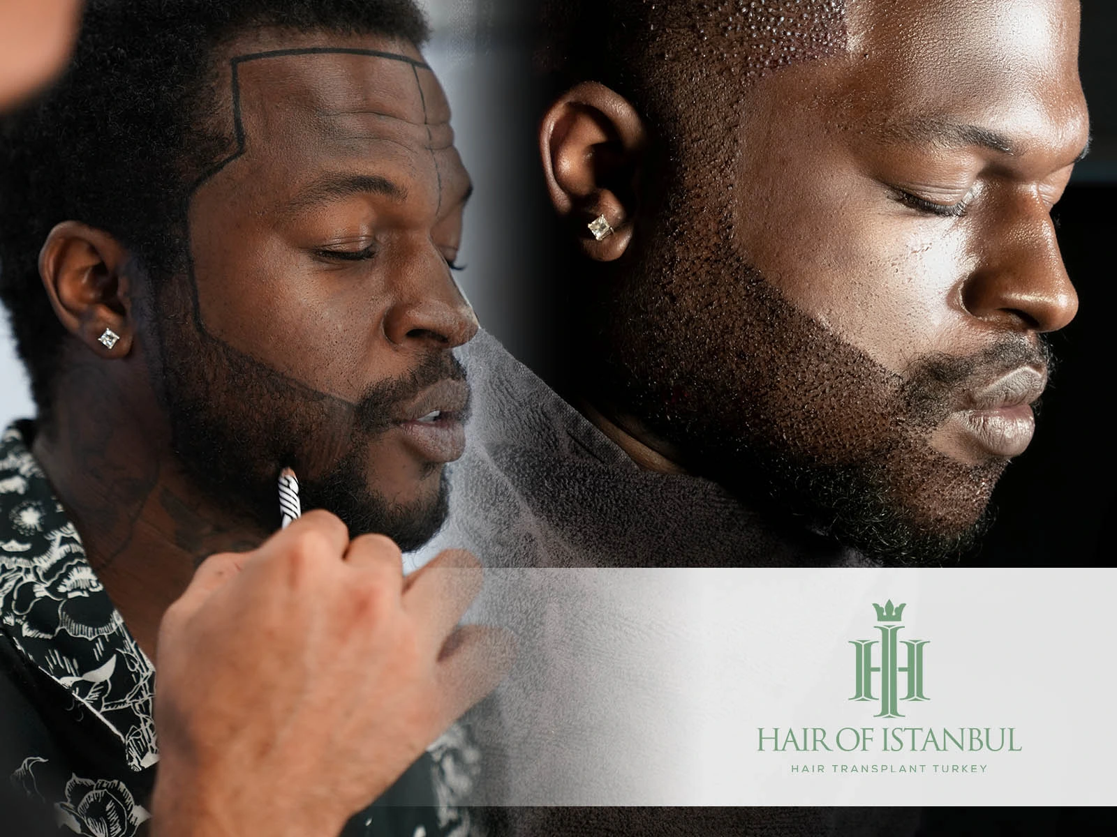 Beard Transplant: The Rising Trend for a Defined Look in 2025