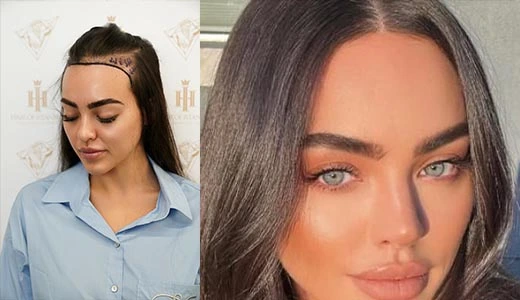 Before and After Hairline Lowering vs Women Hair Transplant
