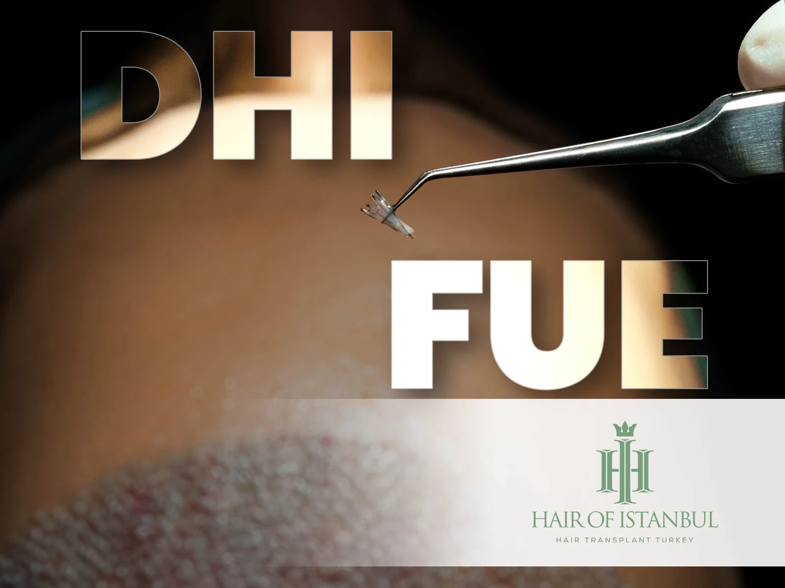 DHI vs FUE Hair Transplant: Which Technique Fits Your Hair Goals?