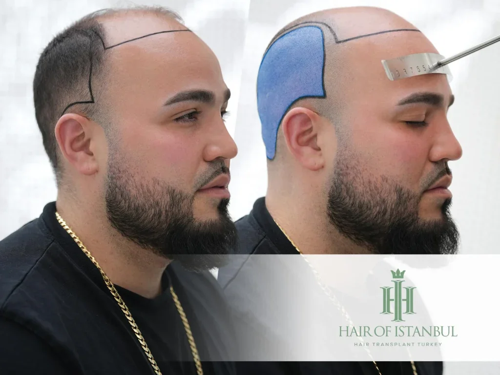 Donor Area for Hair Transplant: Density, Limits and Healing