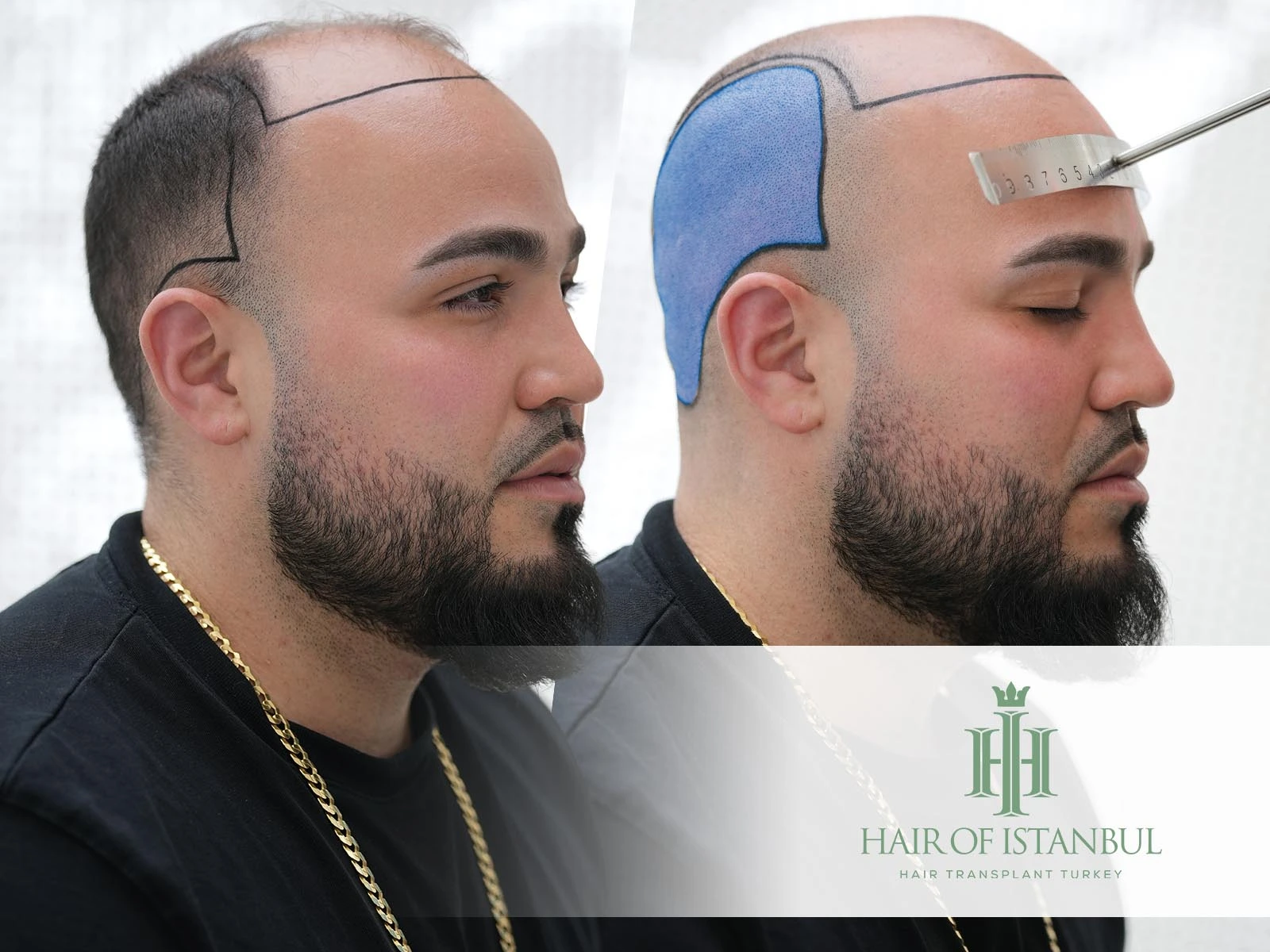 Donor Area for Hair Transplant: What You Should Know Before Surgery