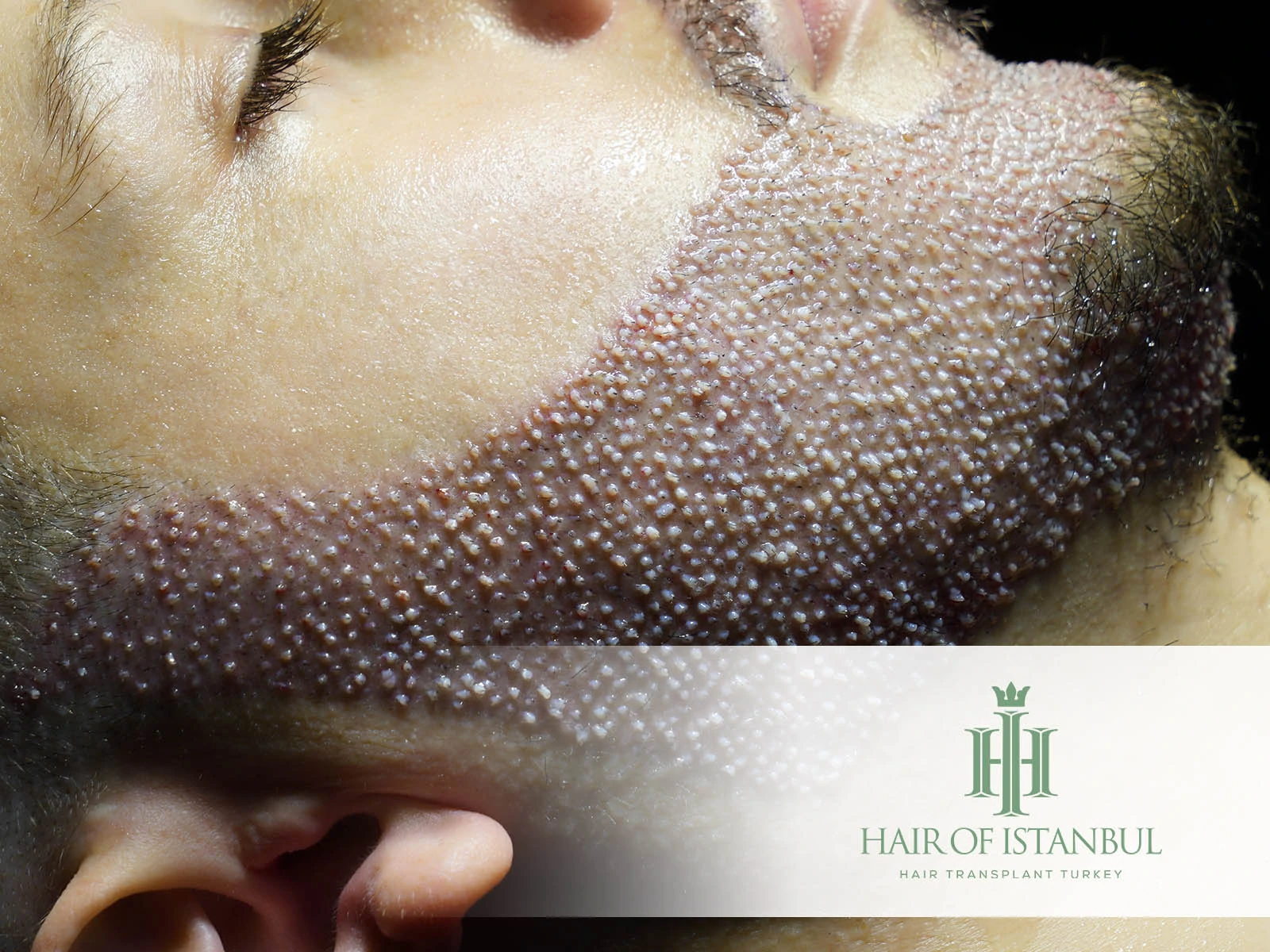 FUE Beard Transplant: What It Is and Why It’s the Gold Standard for Natural Beard Restoration