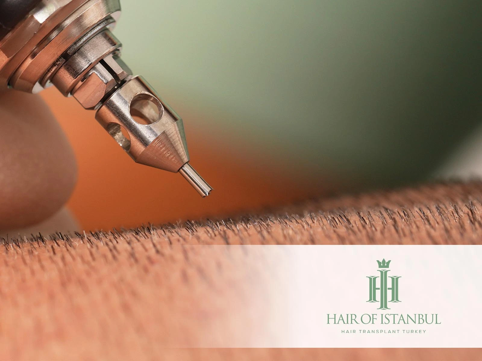 FUE Donor Hair Transplant: Natural Results with Minimal Scarring