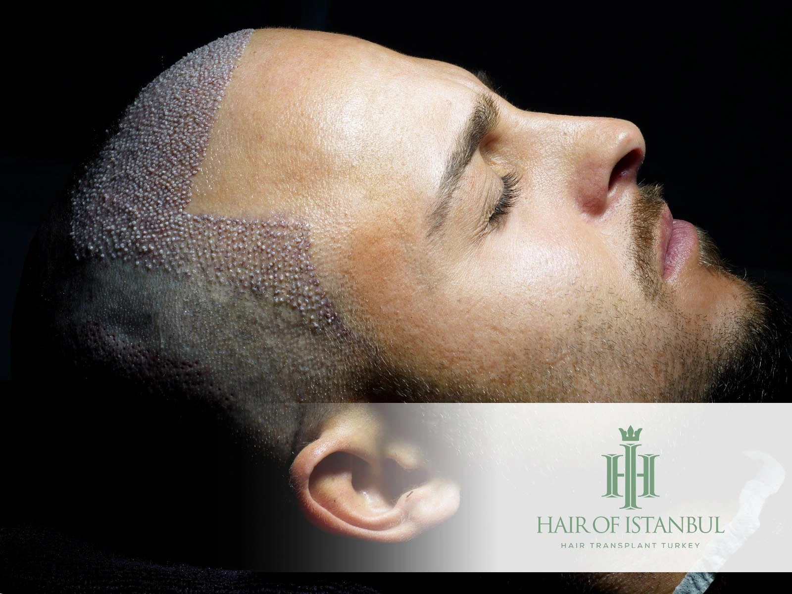 FUE Hair Transplant Timeline: Full Recovery & Growth Guide