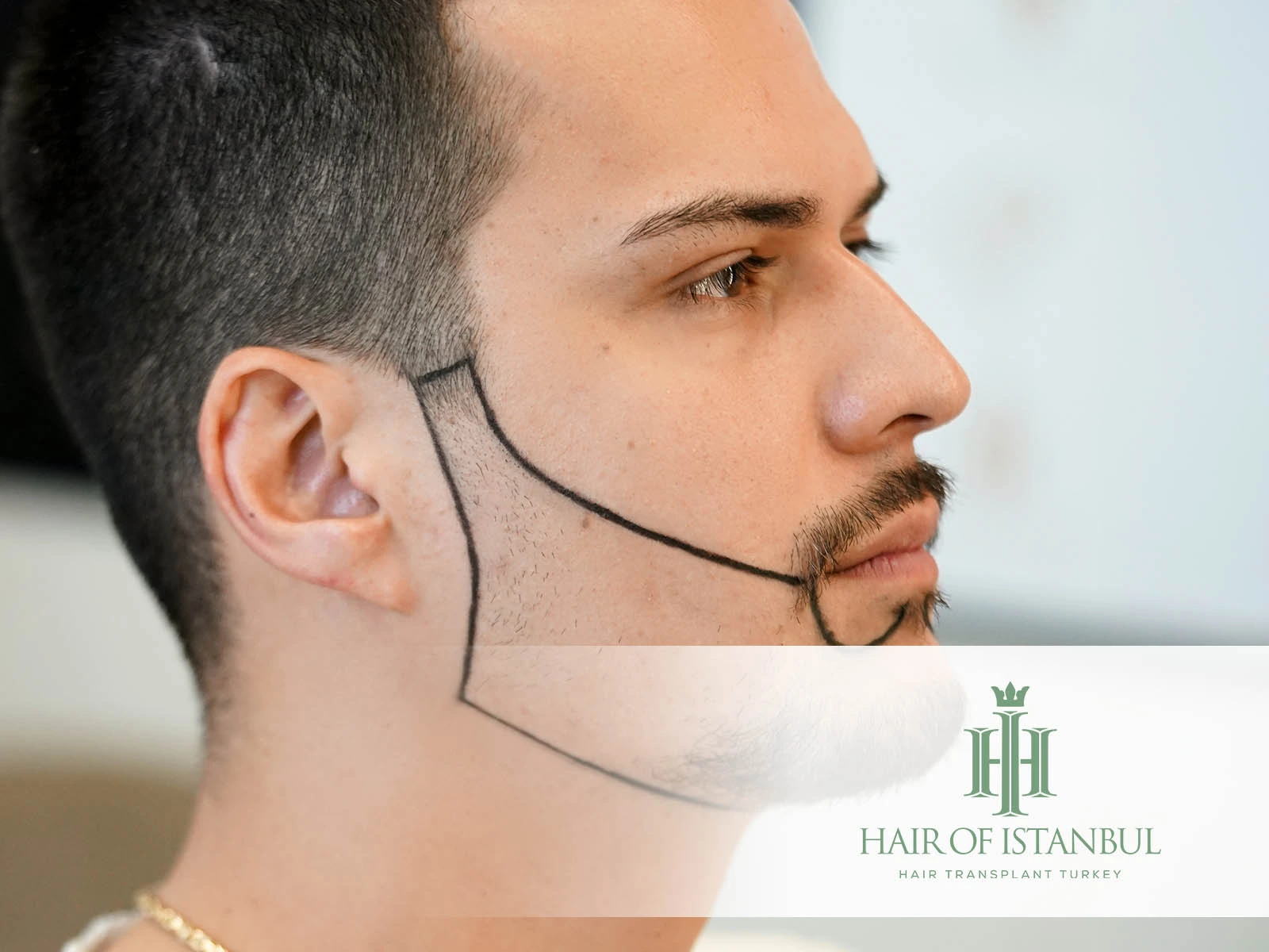 Facial Hair Transplant 101: What to Know Before You Commit
