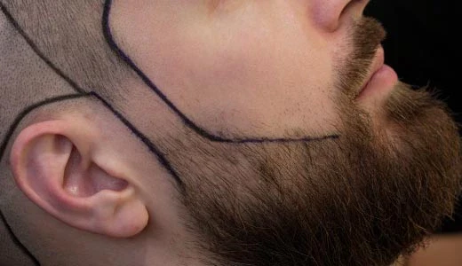 Factors That Influence Beard Hair Transplant Results