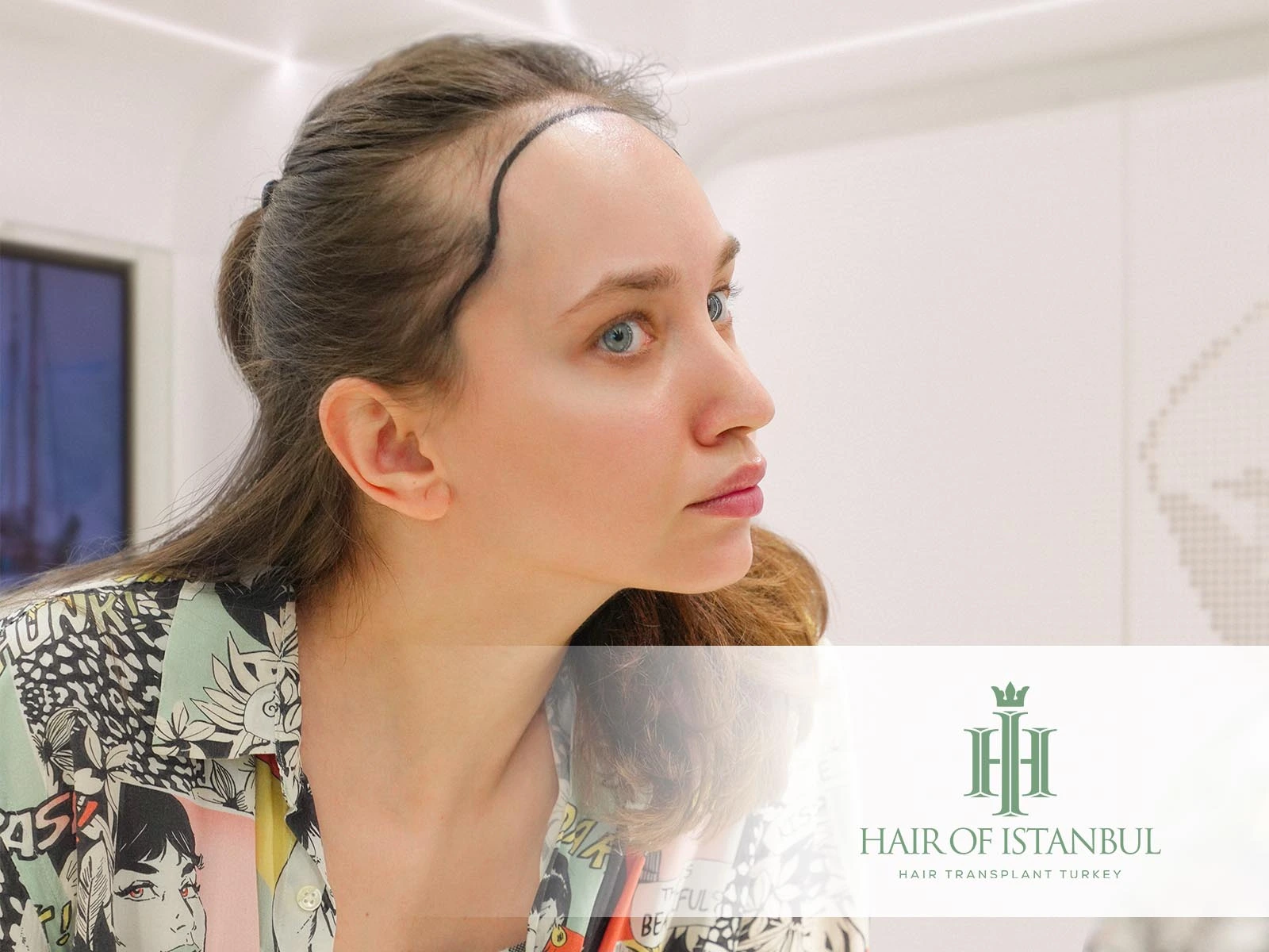 Female Hair Transplant Recovery: What Women Should Expect?