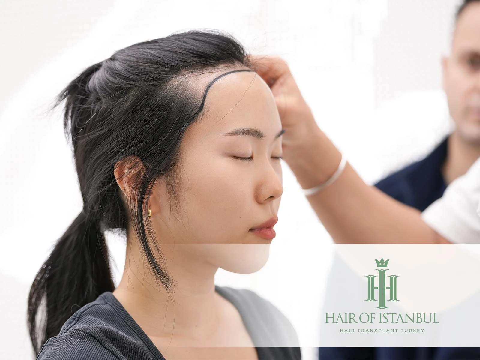 Female Hair Transplant: When Hair Restoration Becomes the Right Solution
