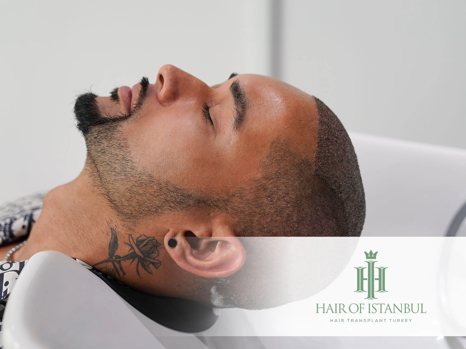 First Hair Wash After Hair Transplant: A Crucial Step Toward Long-Term Results