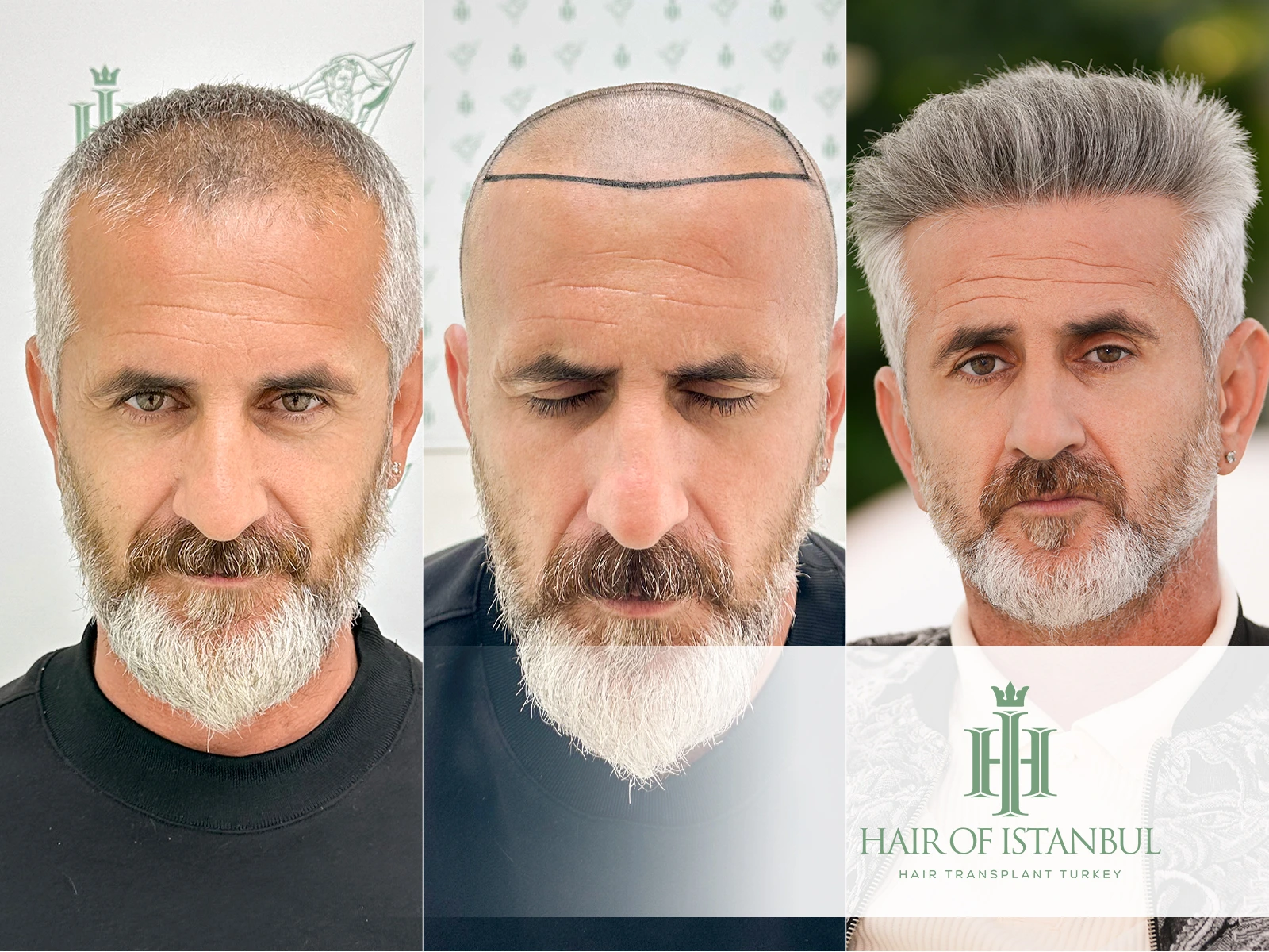 Hair Transplant After 8 Months: What Real Results Look Like