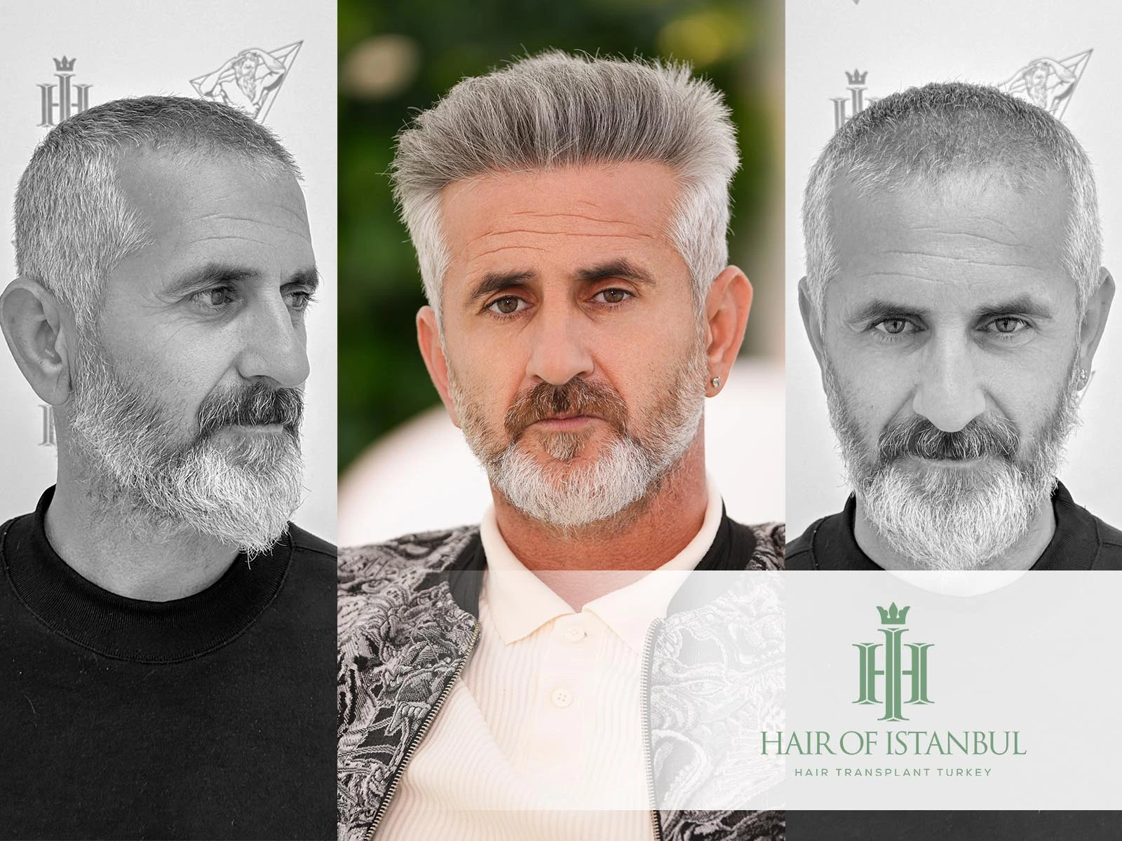 Hair Transplant After: Comprehensive Guide for Best Results