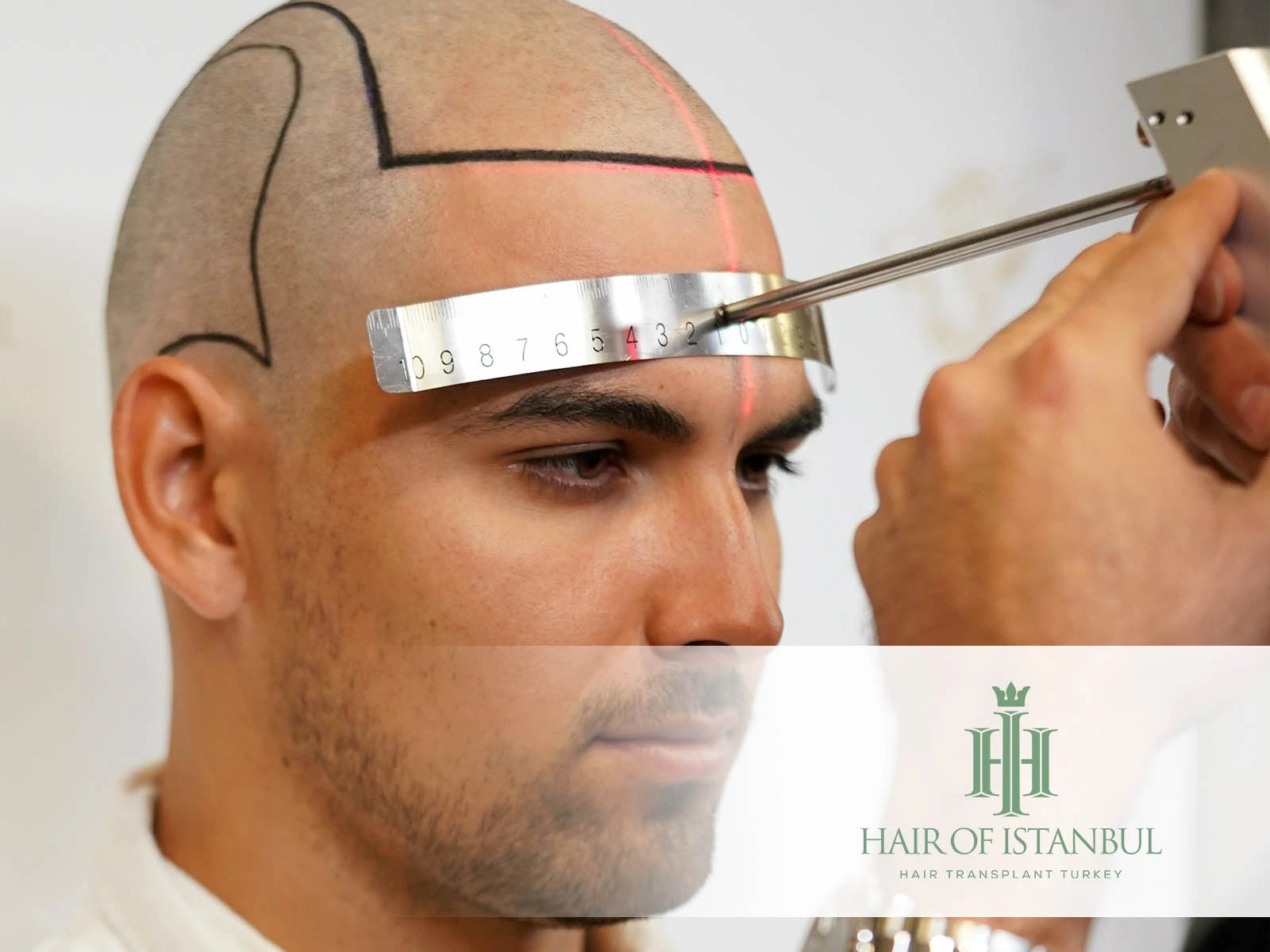 Hair Transplant Aftercare in the First 30 Days: What to Expect