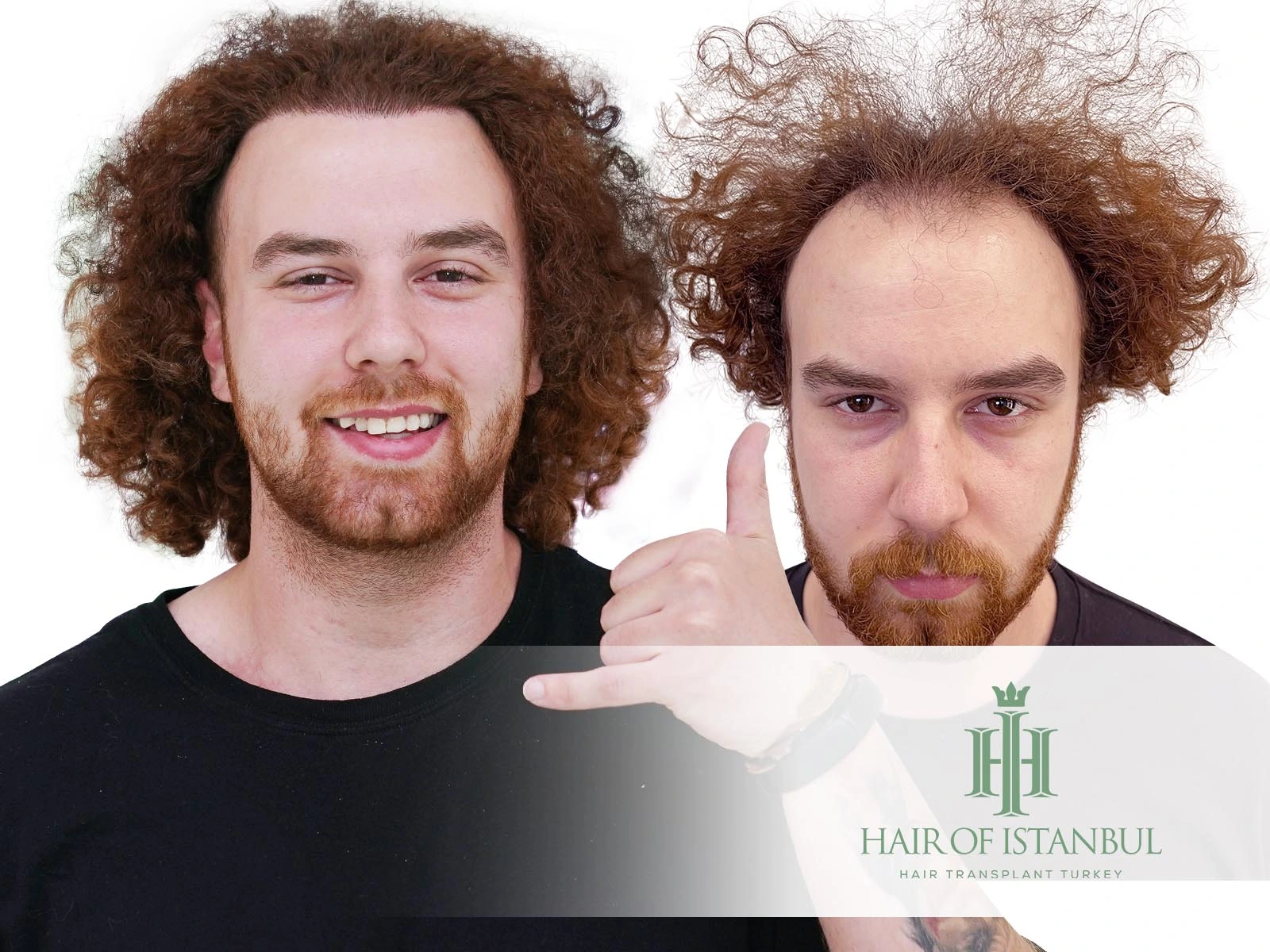 Hair Transplant Curly Hair: Natural and Lasting Results