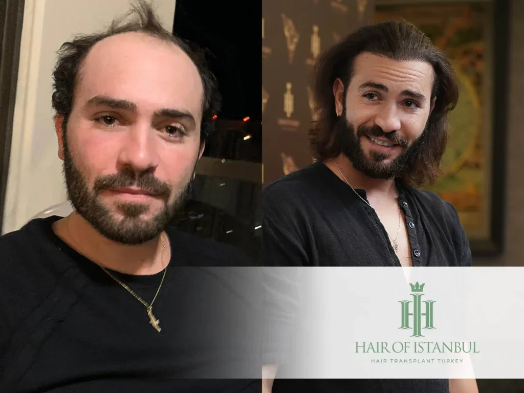 Hair Transplant Growth Stages: Month-by-Month Timeline