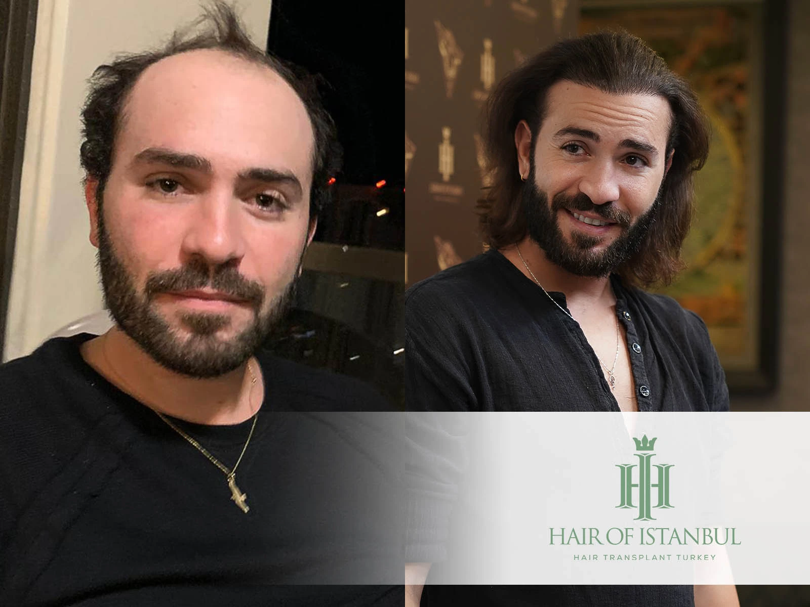 Hair Transplant Growth Stages: What to Expect Month by Month