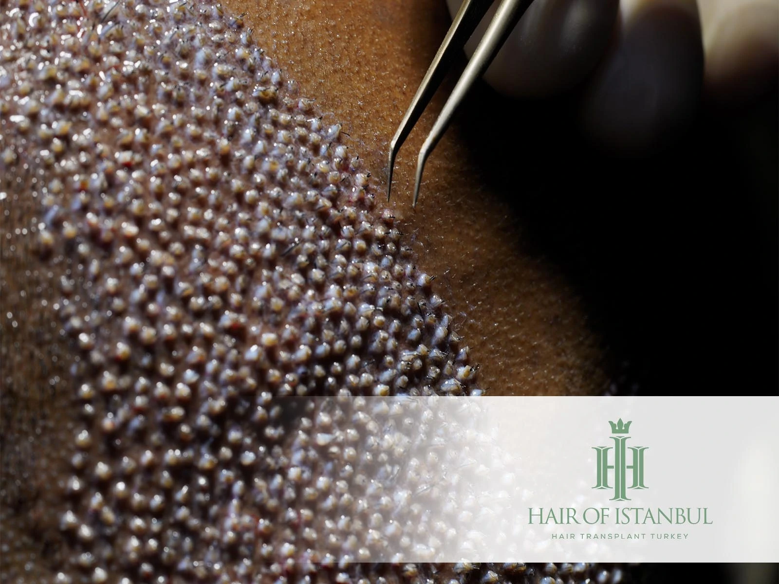 Hair Transplant Holes: Causes, Healing & Prevention Tips