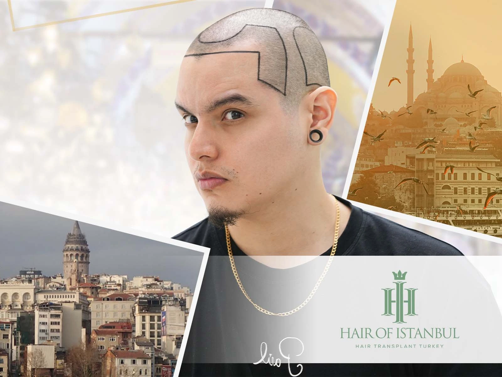 Hair Transplant Istanbul